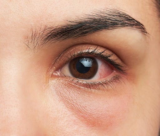علائم التهاب قرنیه چشم